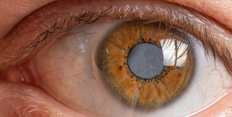 tratamiento para glaucoma