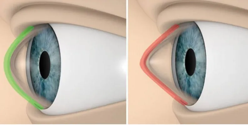 Ilustración médica que contrasta la curvatura normal y redondeada de una córnea sana con la forma cónica de una córnea afectada por queratocono