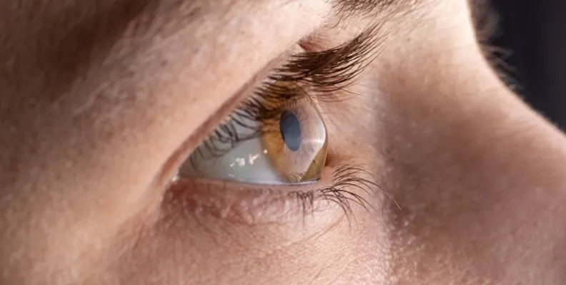 Detalle del abultamiento de la córnea en un ojo humano, un signo visible de la patología conocida como queratocono