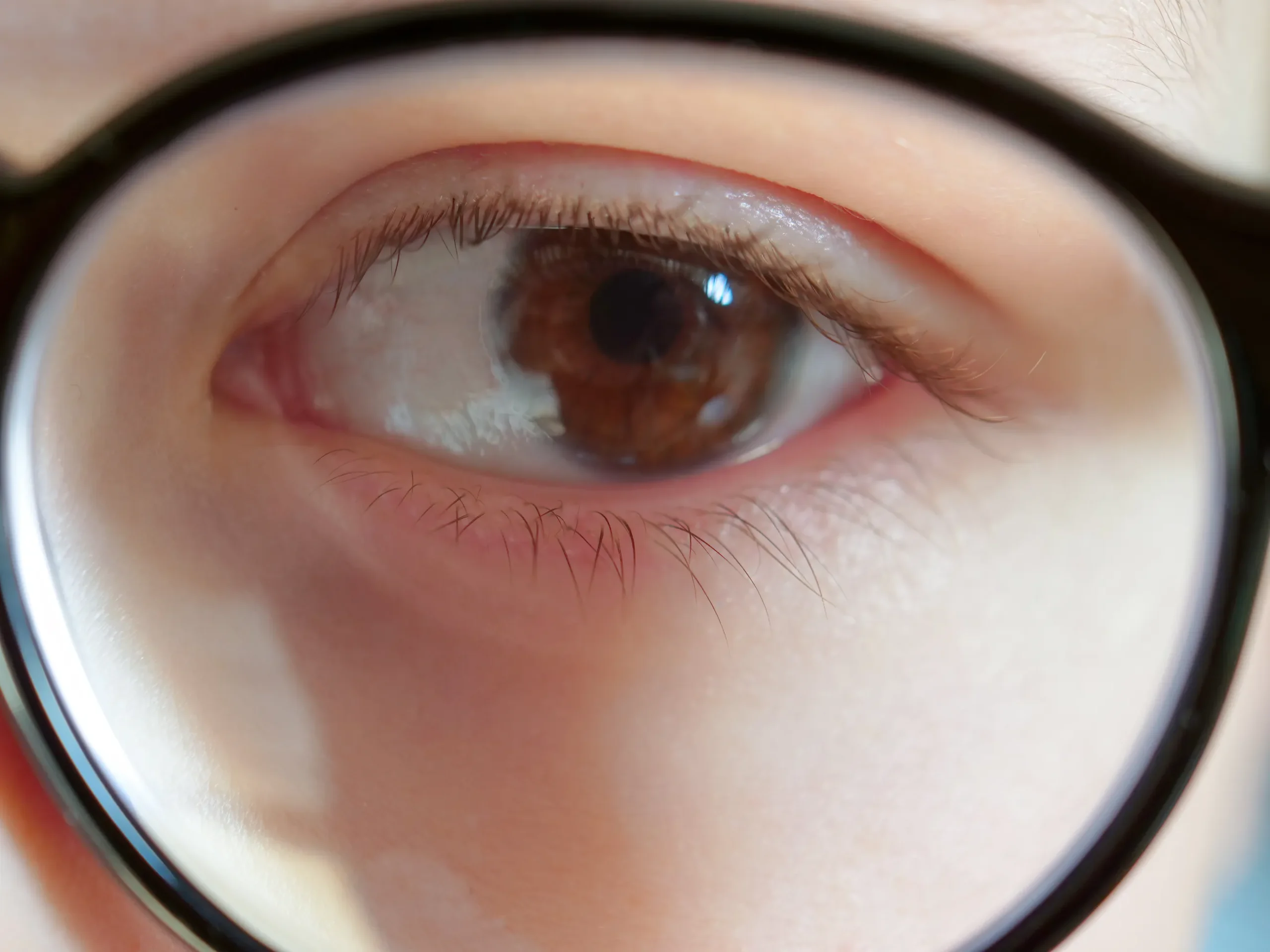 Macro de un ojo infantil a través de un cristal graduado para entender a qué se debe la miopía en edad escolar.