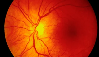 Una fotografía médica de la retina con vasos sanguíneos para explicar por qué es peligroso el desprendimiento de retina.