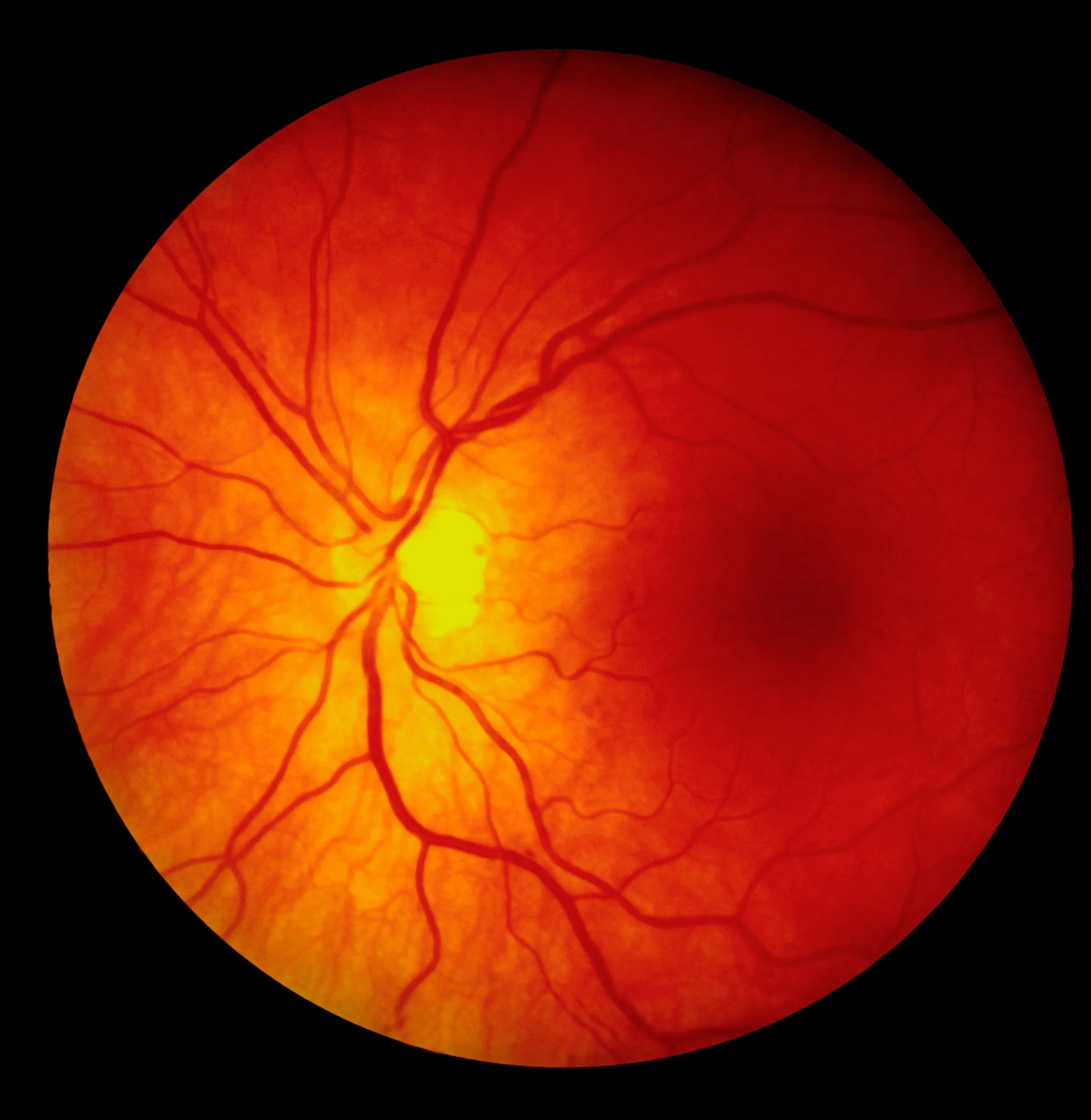 Una fotografía médica de la retina con vasos sanguíneos para explicar por qué es peligroso el desprendimiento de retina.