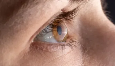 Primer plano de un perfil ocular con deformidad de la córnea para ilustrar qué es queratocono y cómo se corrige hoy.