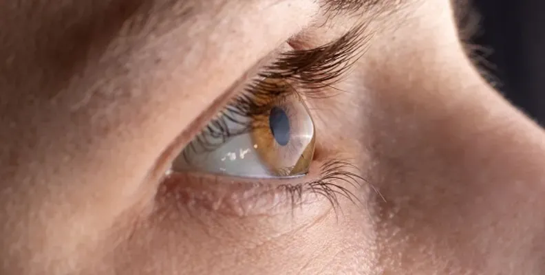 Primer plano de un perfil ocular con deformidad de la córnea para ilustrar qué es queratocono y cómo se corrige hoy.
