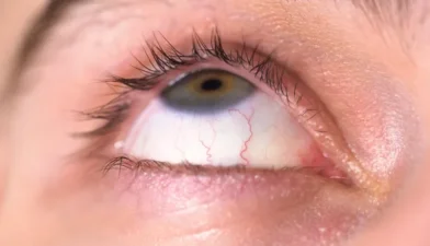 Primer plano de un ojo humano irritado donde se aprecian los vasos sanguíneos debido a un síntoma de ojo seco