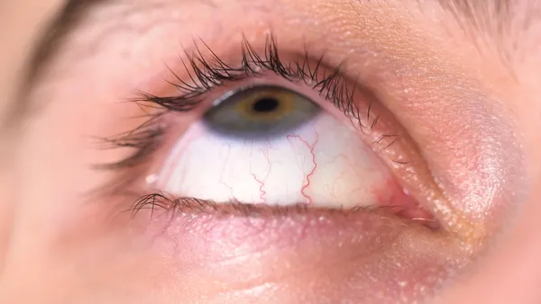 Primer plano de un ojo humano irritado donde se aprecian los vasos sanguíneos debido a un síntoma de ojo seco
